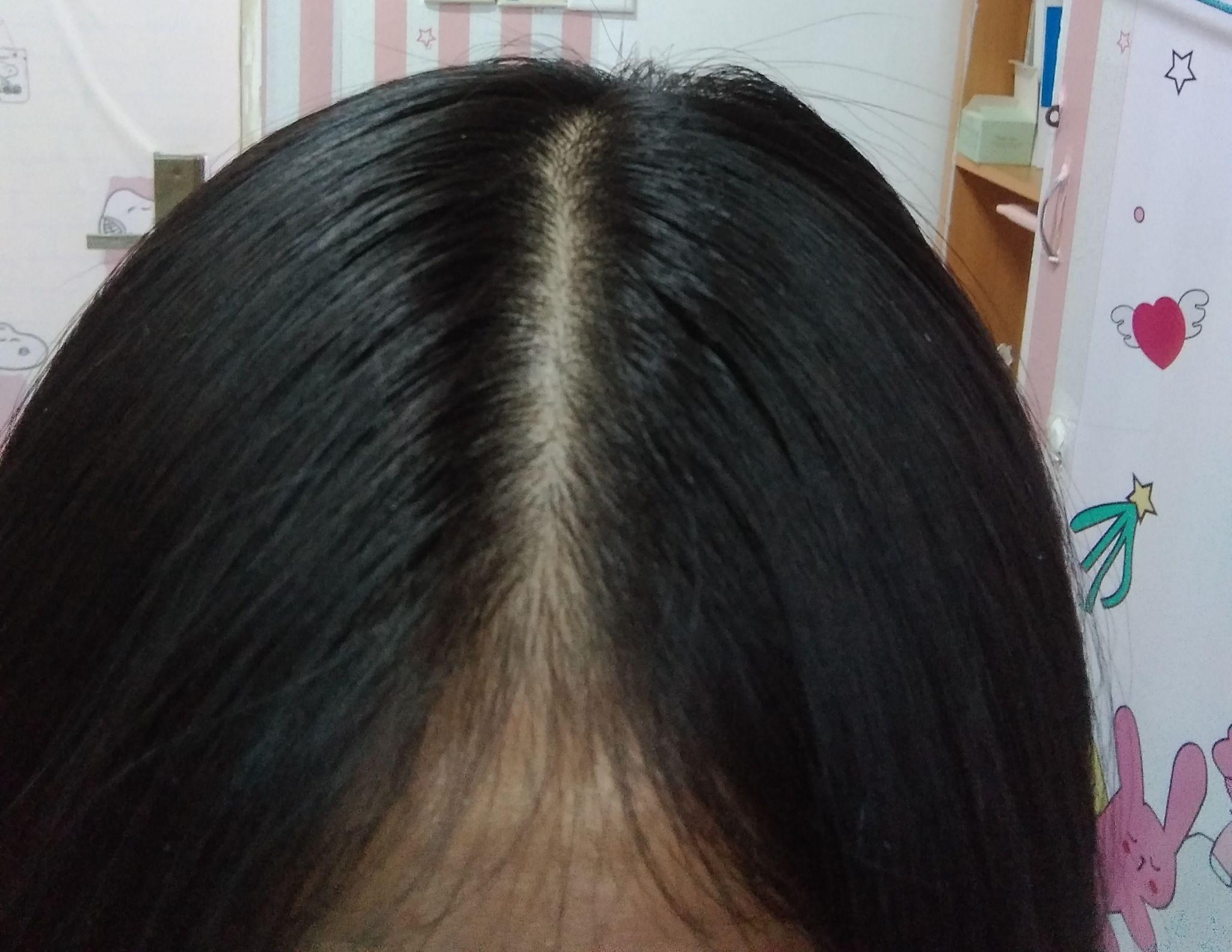 请问女孩子散开头发头顶是这样的算秃吗