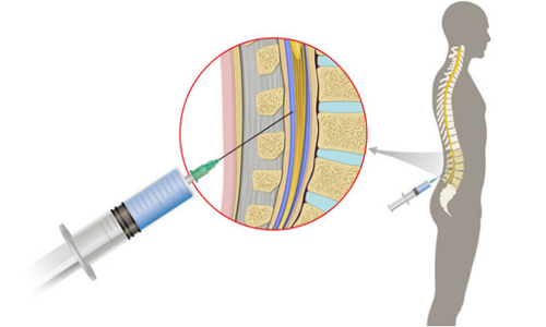 腰椎穿刺测压管图片图片