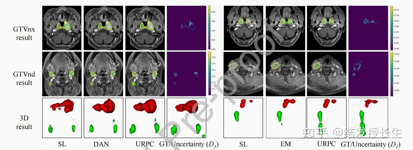 【半监督图像分割】Semi-Supervised Medical Image Segmentation via Uncertainty ...