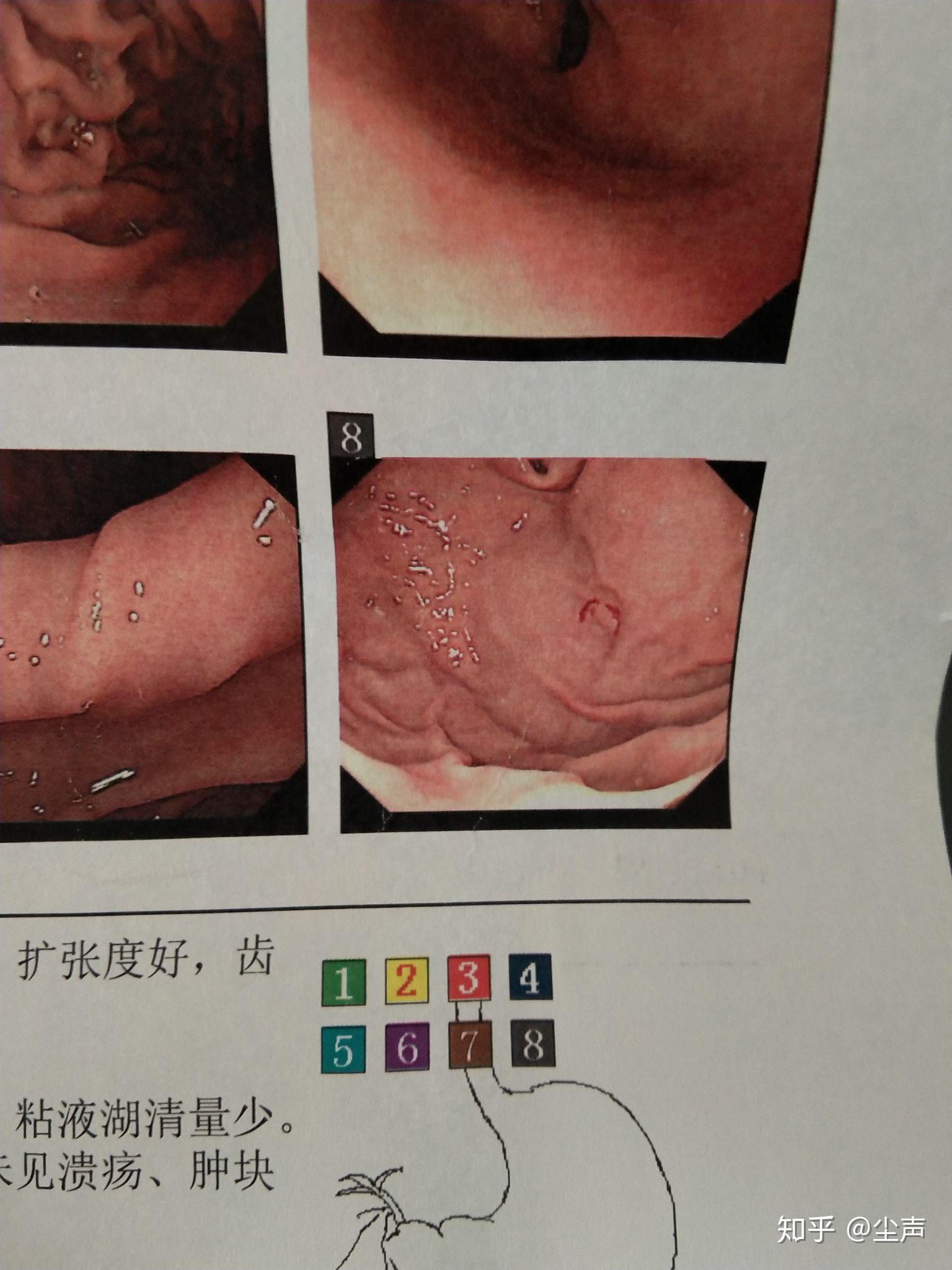 15年2月底,我因胃难受去医院做了胃镜,诊断是慢性浅表性胃炎,病理是
