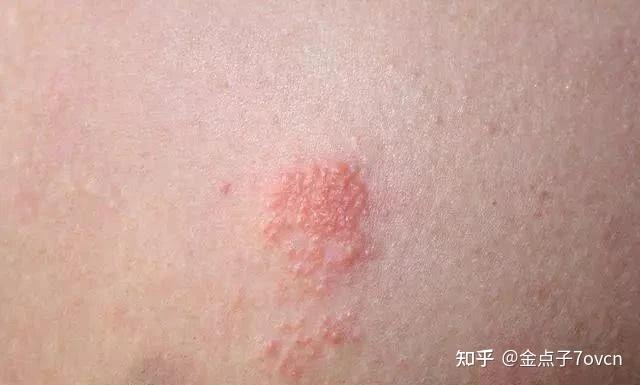 疱疹是因为什么原因引起的 - 知乎