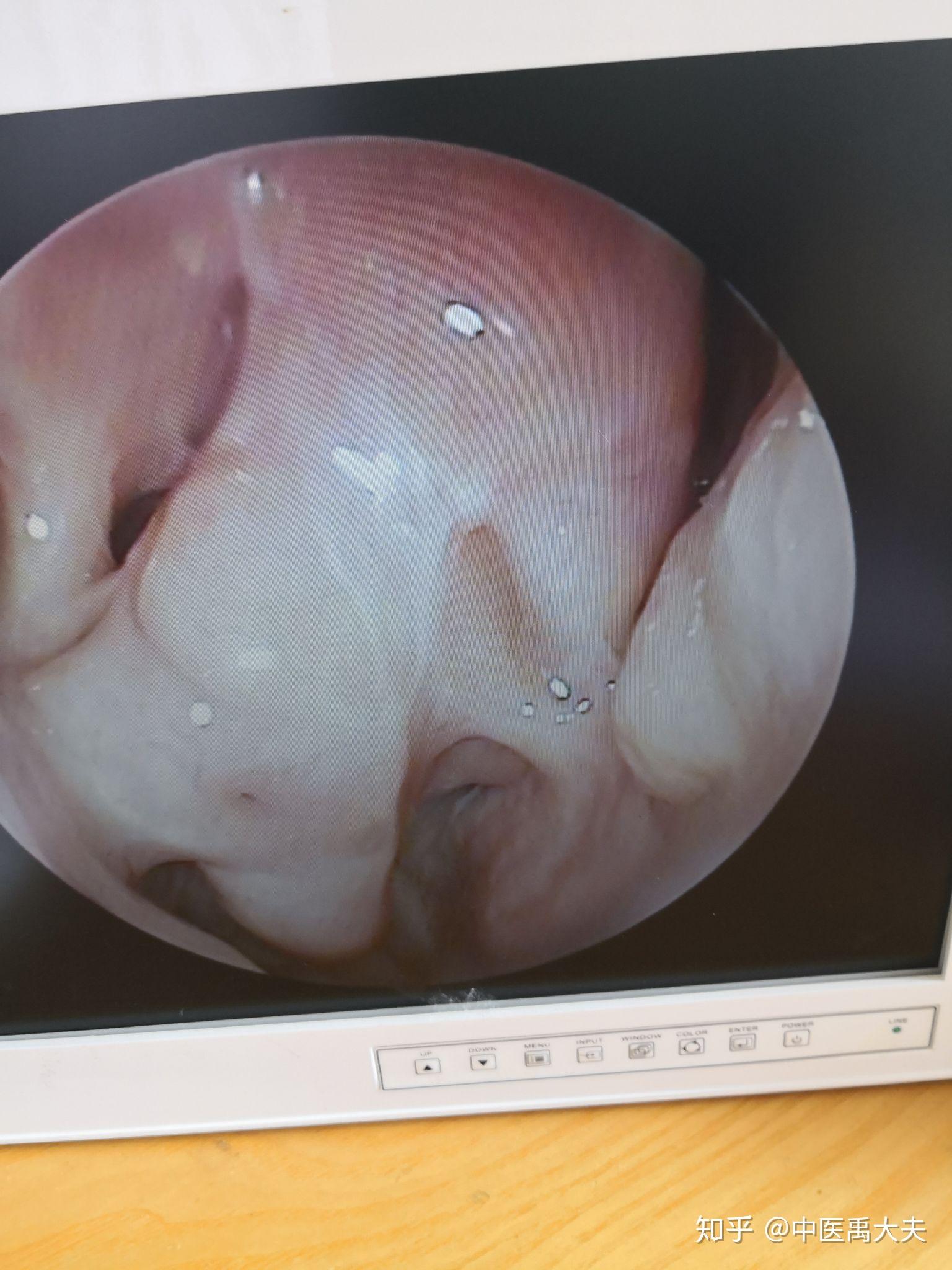 鼻炎严重导致鼻腔堵塞使用口呼吸有没有什么解决办法