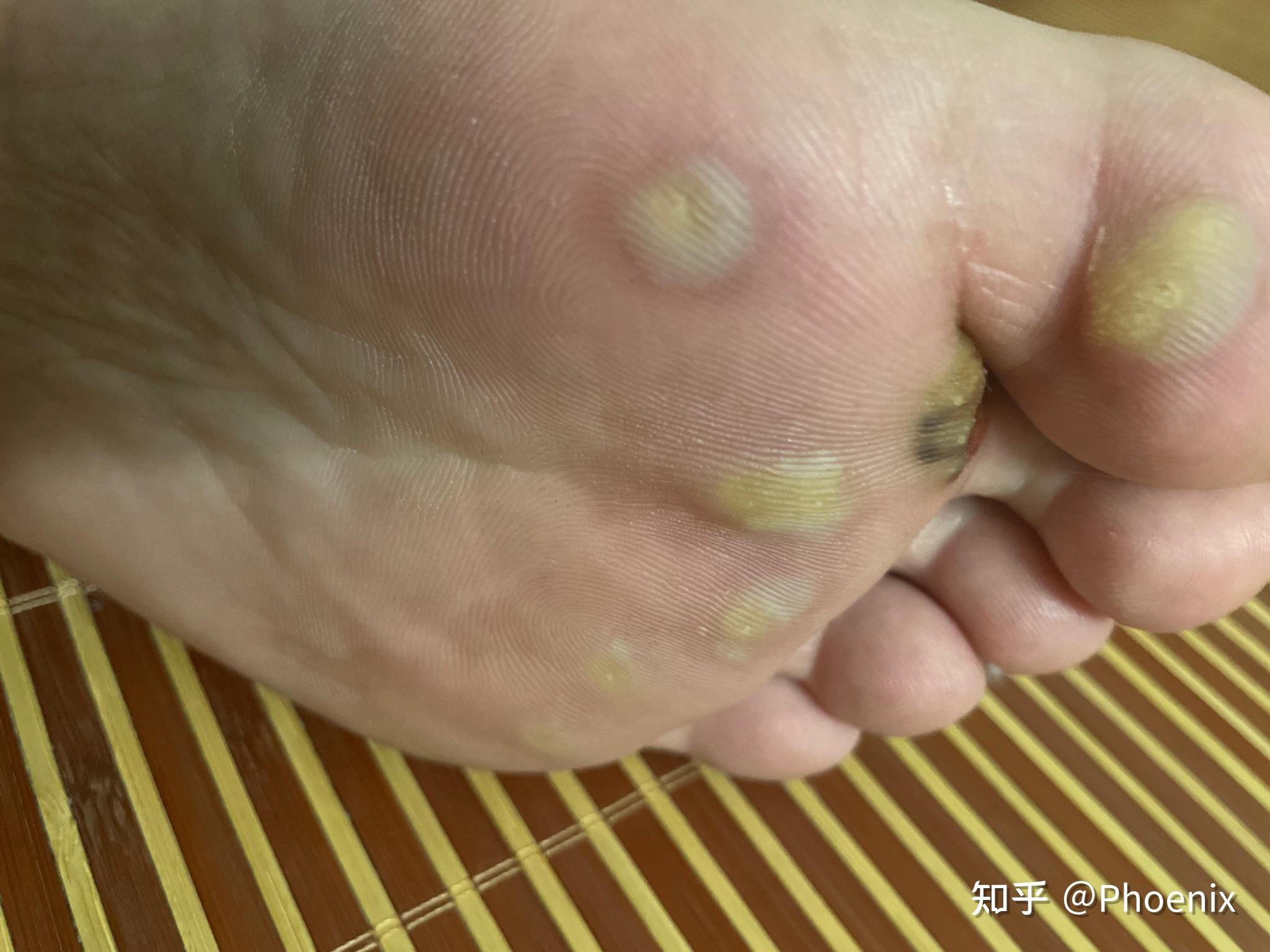 跖疣冷冻后没有起水泡请问怎么回事