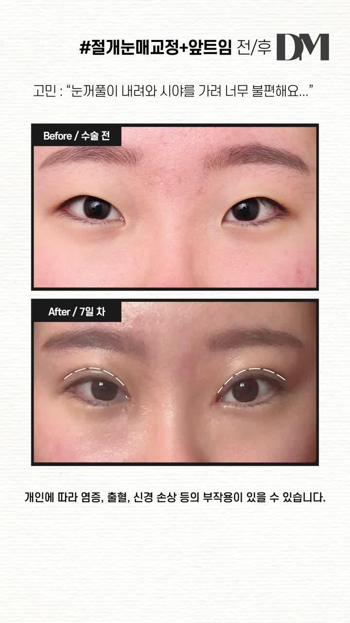 dm迪美切开眼型矫正前后眼角前后对比相比之前的眼型状态要流畅温和