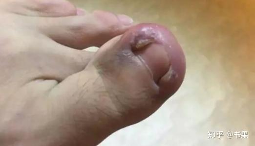 甲沟炎,甲下脓肿怎么办,指甲的部分已经化脓了,里面都干掉了,呈淡黄色