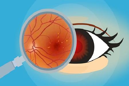 首大马玲珍:糖尿病性视网膜病变会引发那些并发症