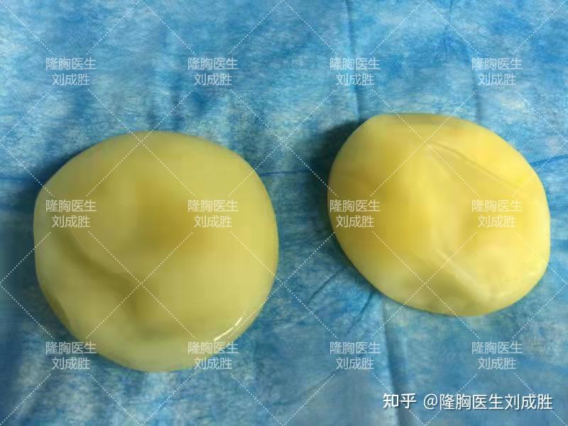 隆胸假体取出能否恢复原样