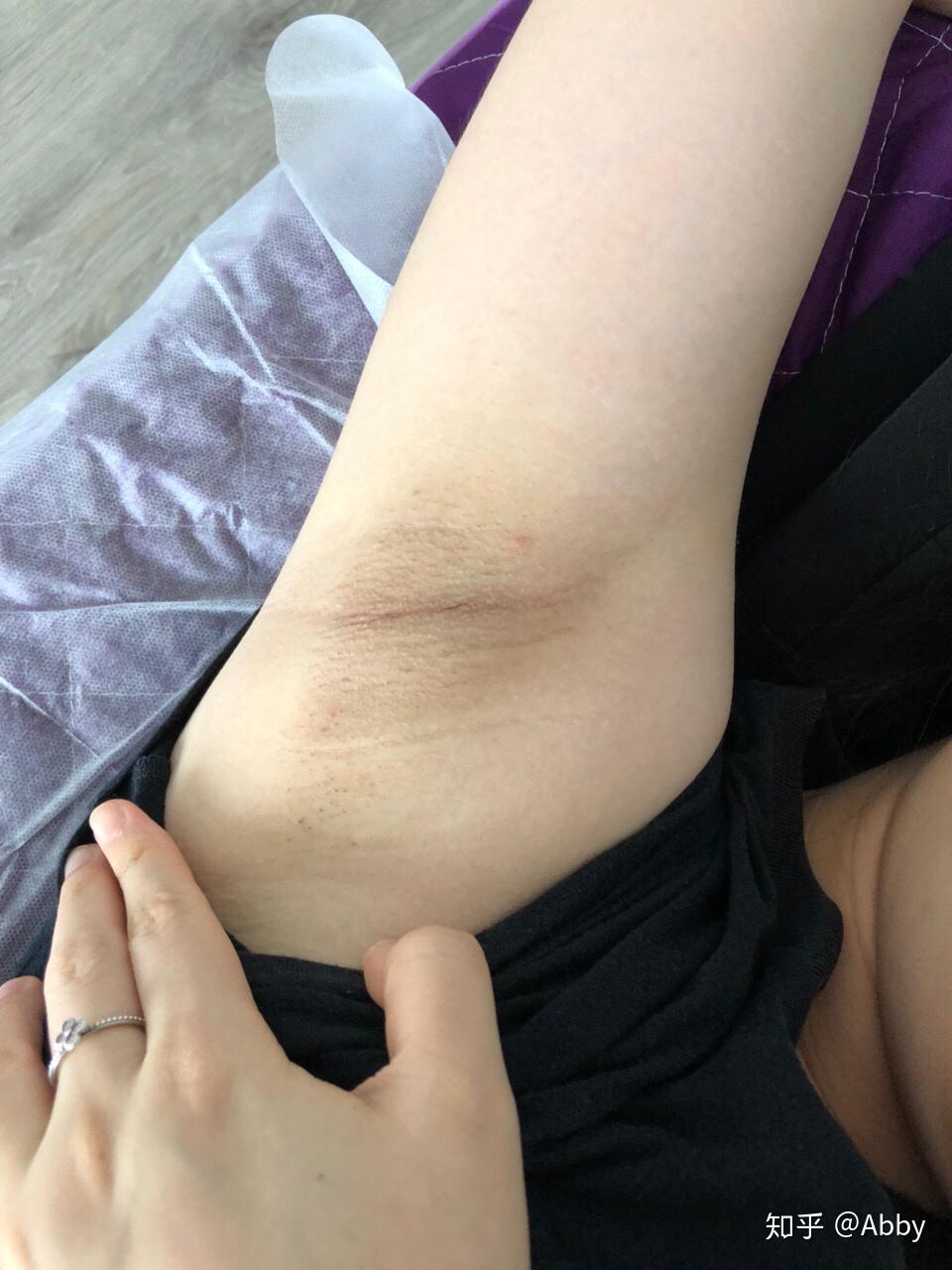 腋毛长该如何处理