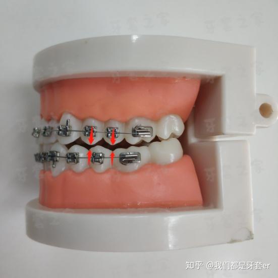 正常牙齿咬合是怎样的?