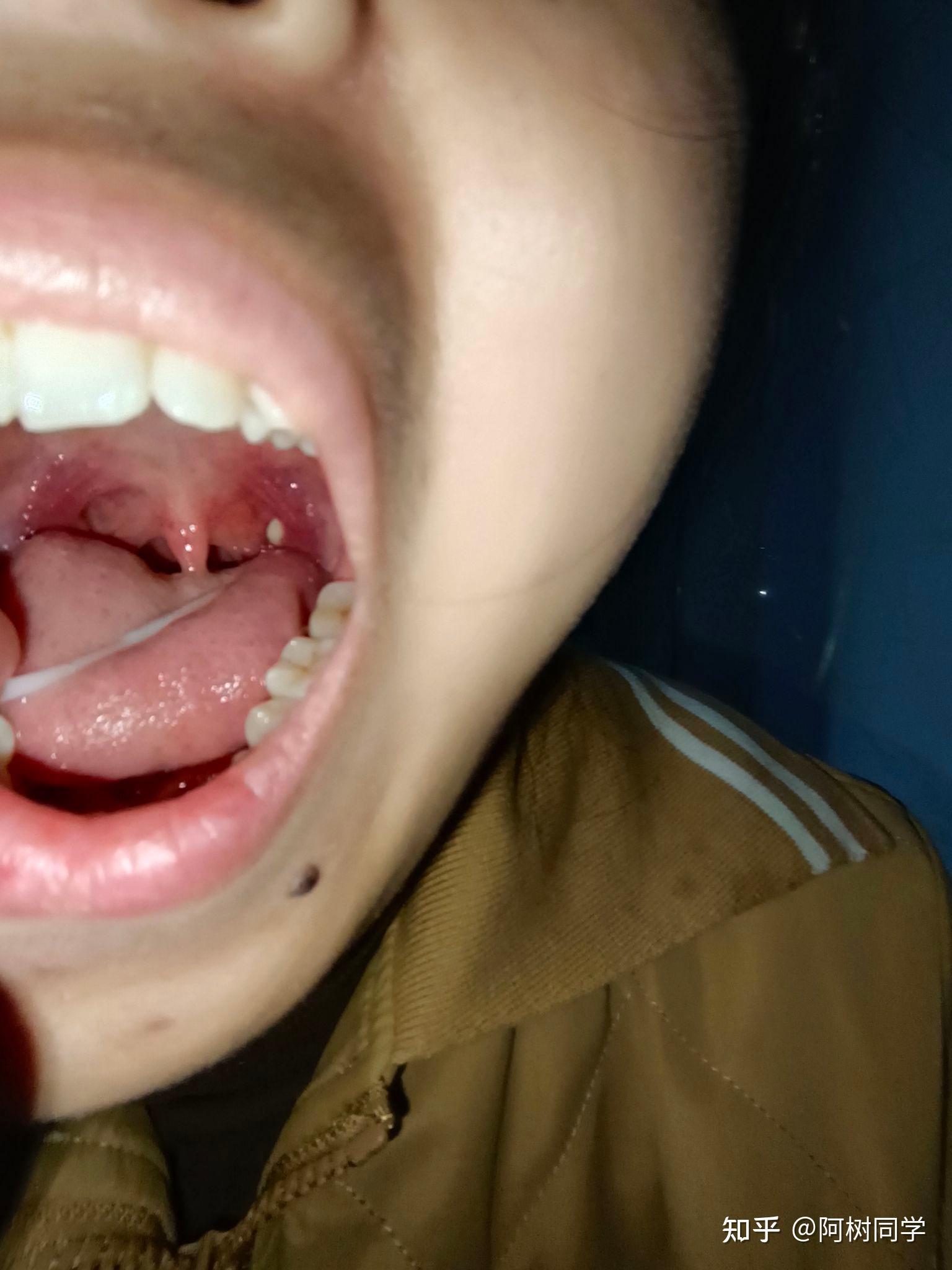 嘴巴里长了个白色肉疙瘩,绿豆大小,不疼不痒,有异物感,是凸出来的的