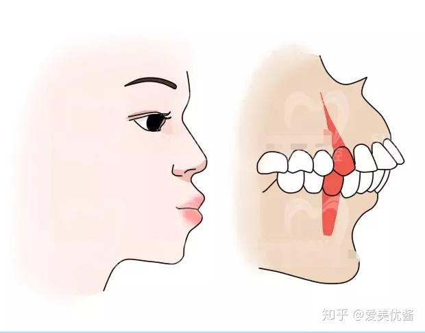 怎样判断嘴凸是骨性的还是牙性的? - 知乎