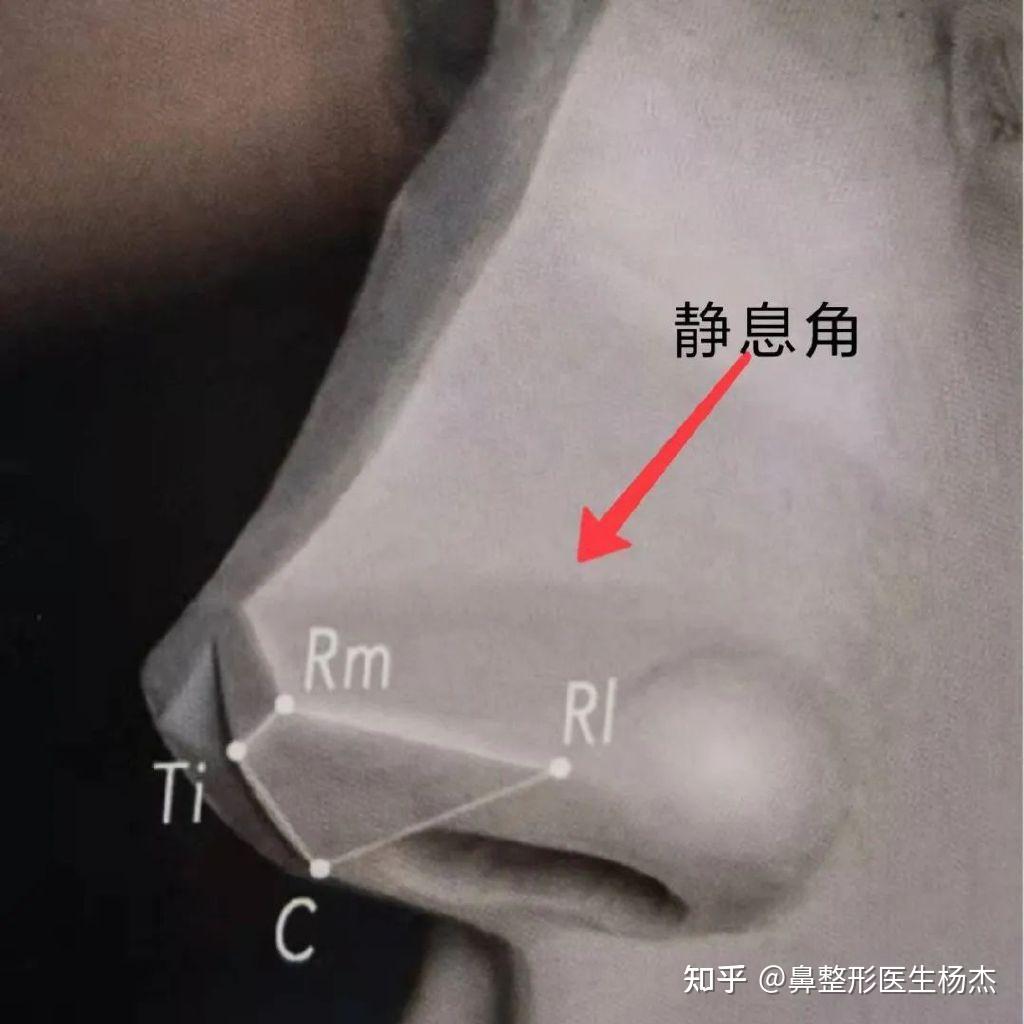 此沟不能少？鼻翼沟成形在鼻头缩小中的重要作用 - 知乎