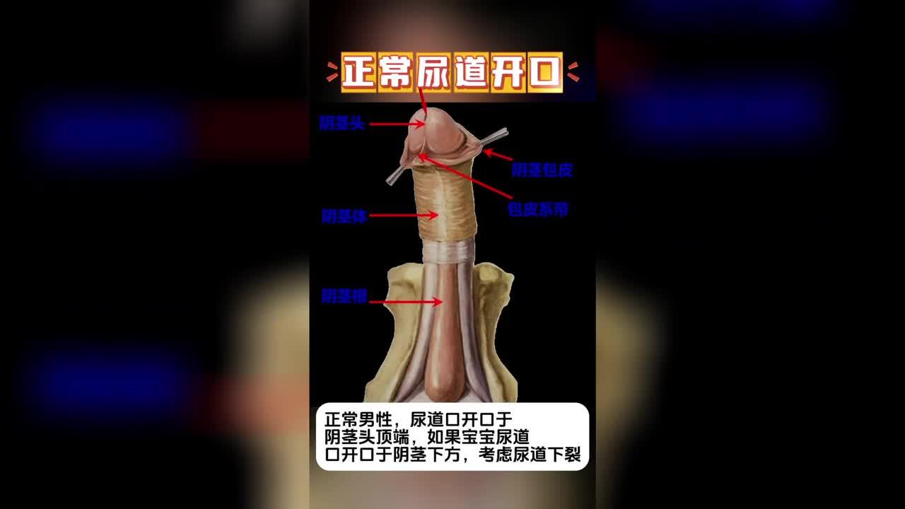 什么是尿道下裂尿道下裂是先天性的吗会不会遗传尿道下裂有什么危害