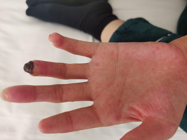 手指发黑雷诺综合征千万别大意严重的患者可能需要截指