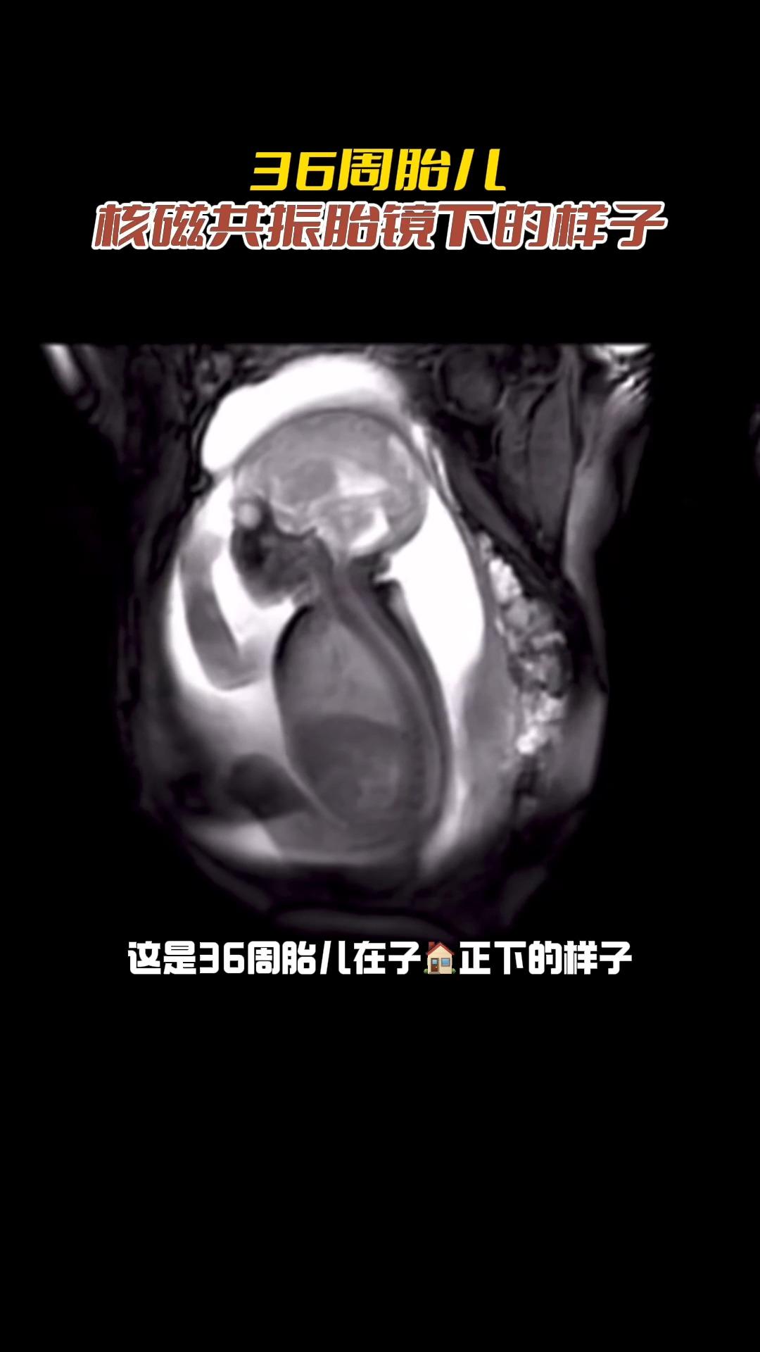 36周胎儿核磁共振胎镜下的样子