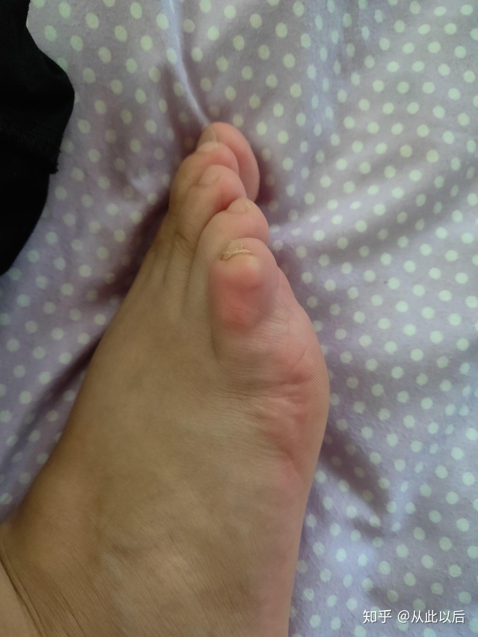 脚上小拇指起了个疙瘩,硬的,一碰就很疼,走路磨的疼,这是茧子吗?