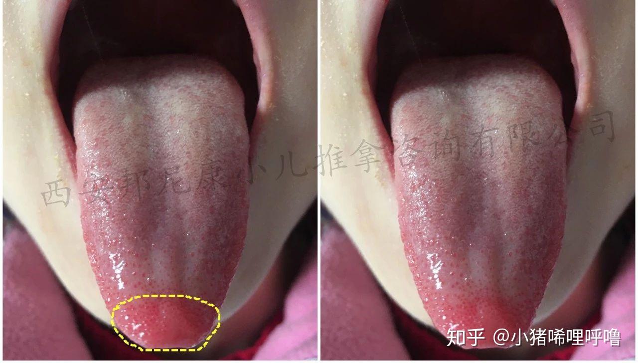 【案例解析】嘴角起疱疹的舌象长什么样? - 知乎