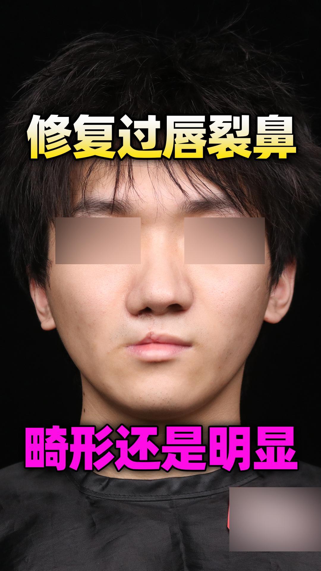 修复过唇裂鼻,畸形还是很明显?