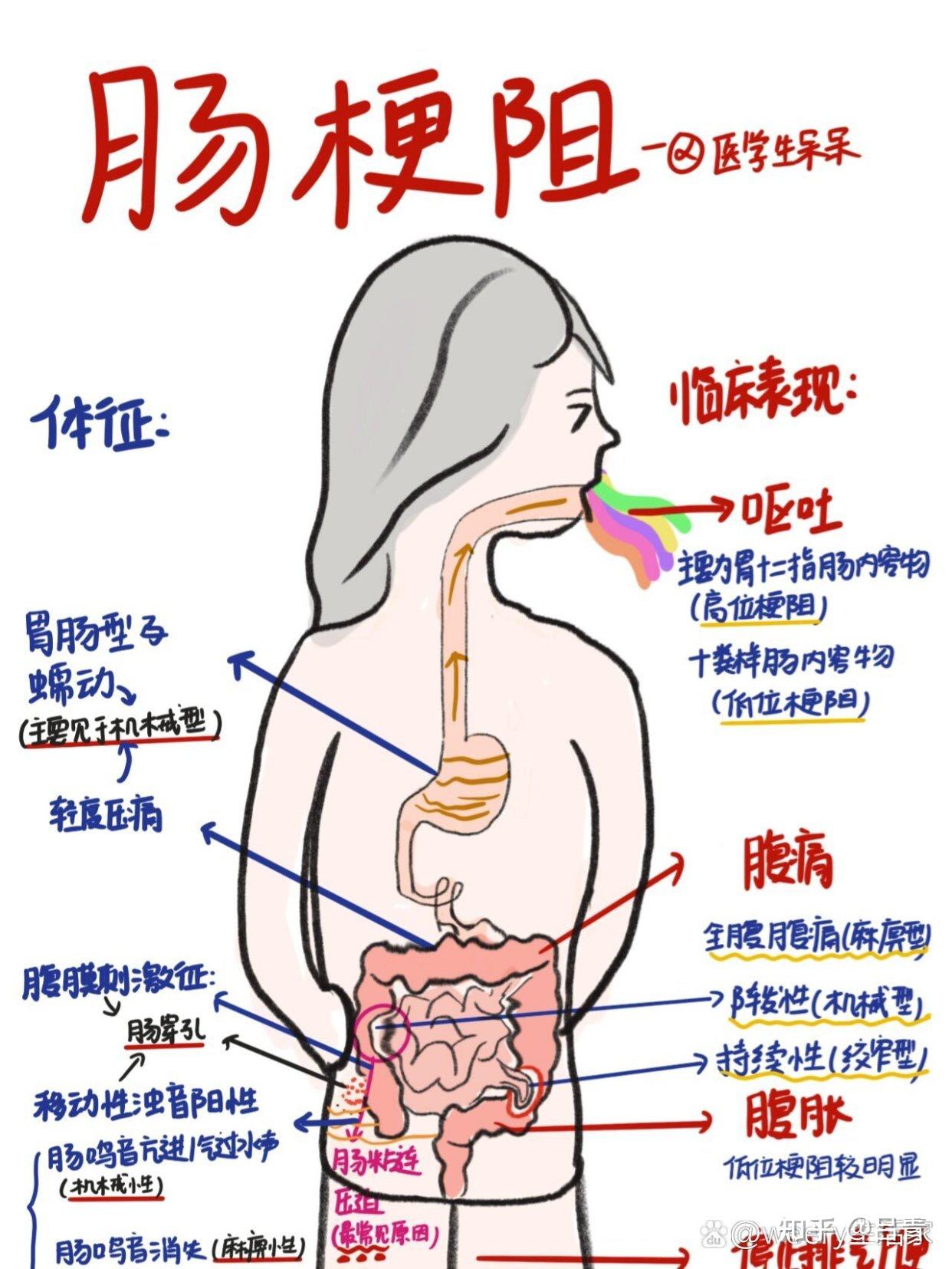 肠梗阻有什么常见的症状?