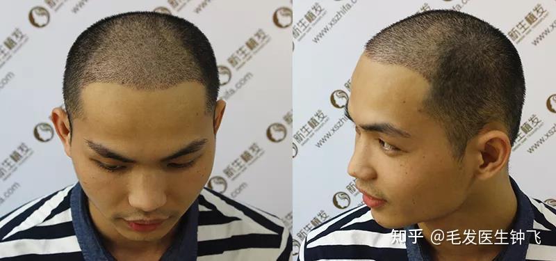 毛发种植现在多少钱