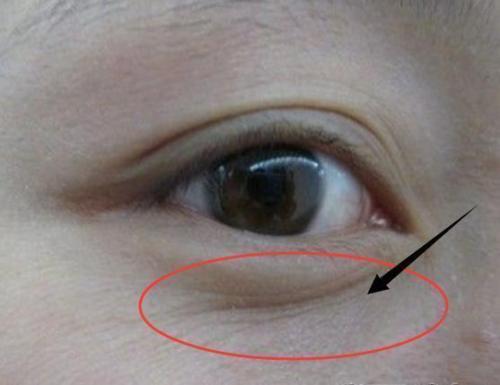 眼下皱纹,怎么去除吗?