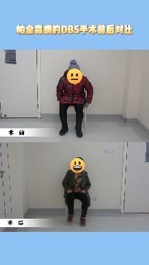 什么是帕金森?怎么预防和治疗?