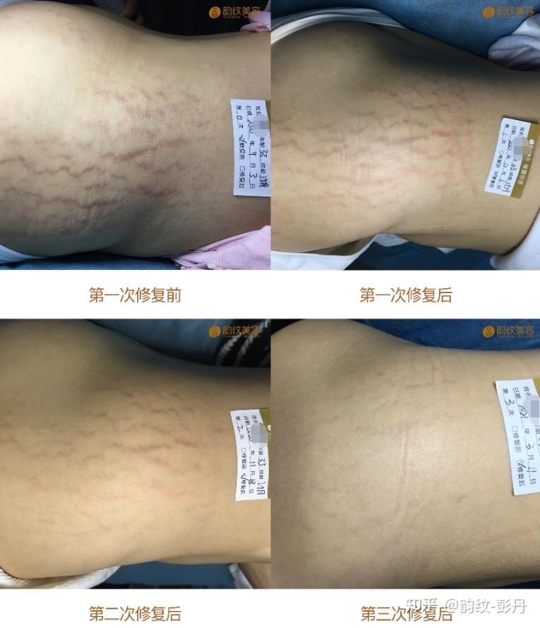 关注问题 67 写回答 登录/注册 臀 肥胖纹 妊娠纹 有人臀部有肥胖