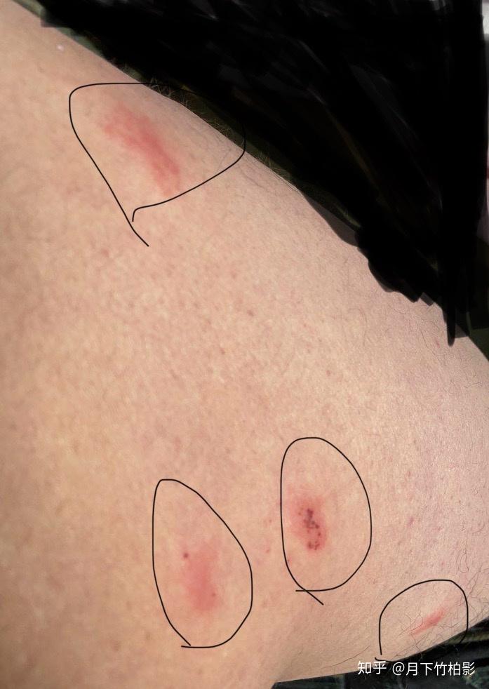 有没有去除床上跳蚤的方法