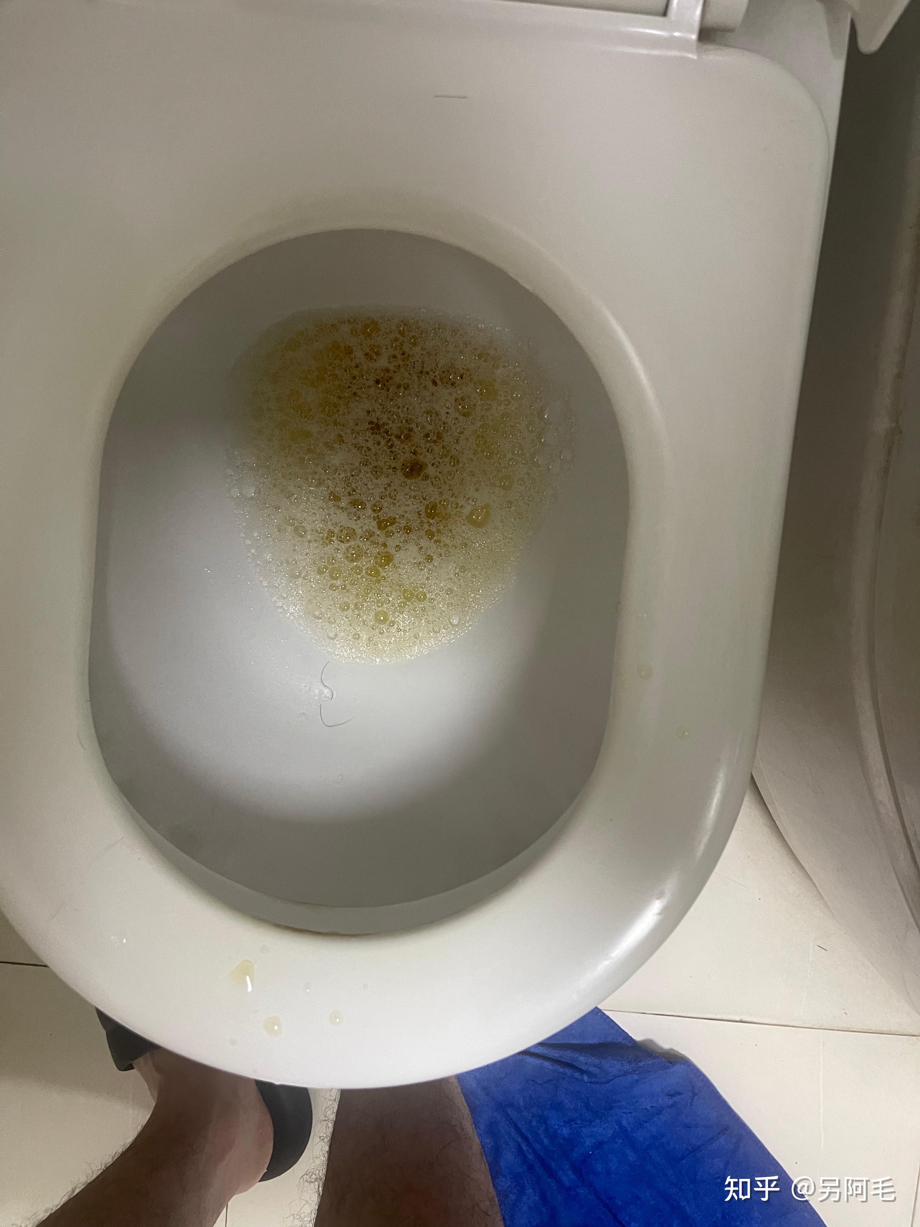 关注问题 ​ 写回答 登录/注册 泌尿 泌尿外科 小便泡沫多是肾有