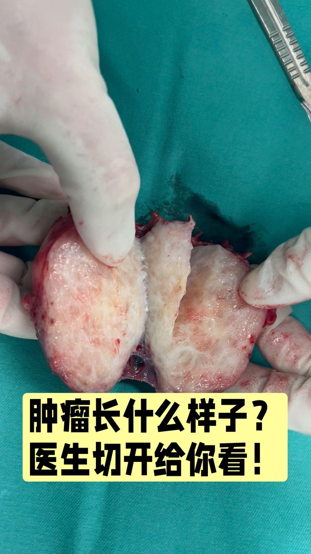 肿瘤长什么样像一个肉丸子里面像鱼肉一样