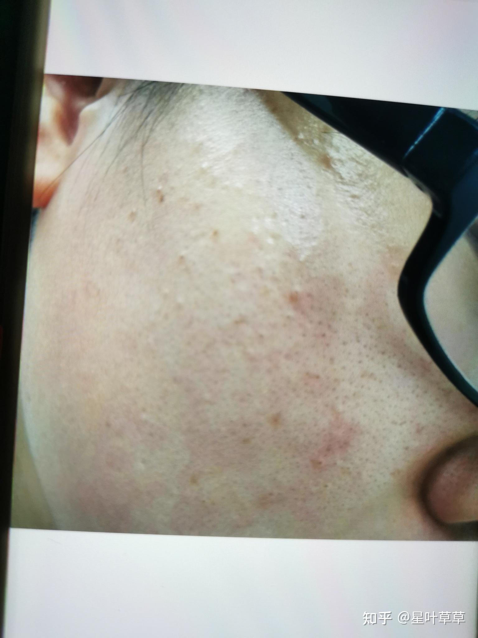 毛孔粗大,两颊泛红,非常严重怎么办? - 知乎