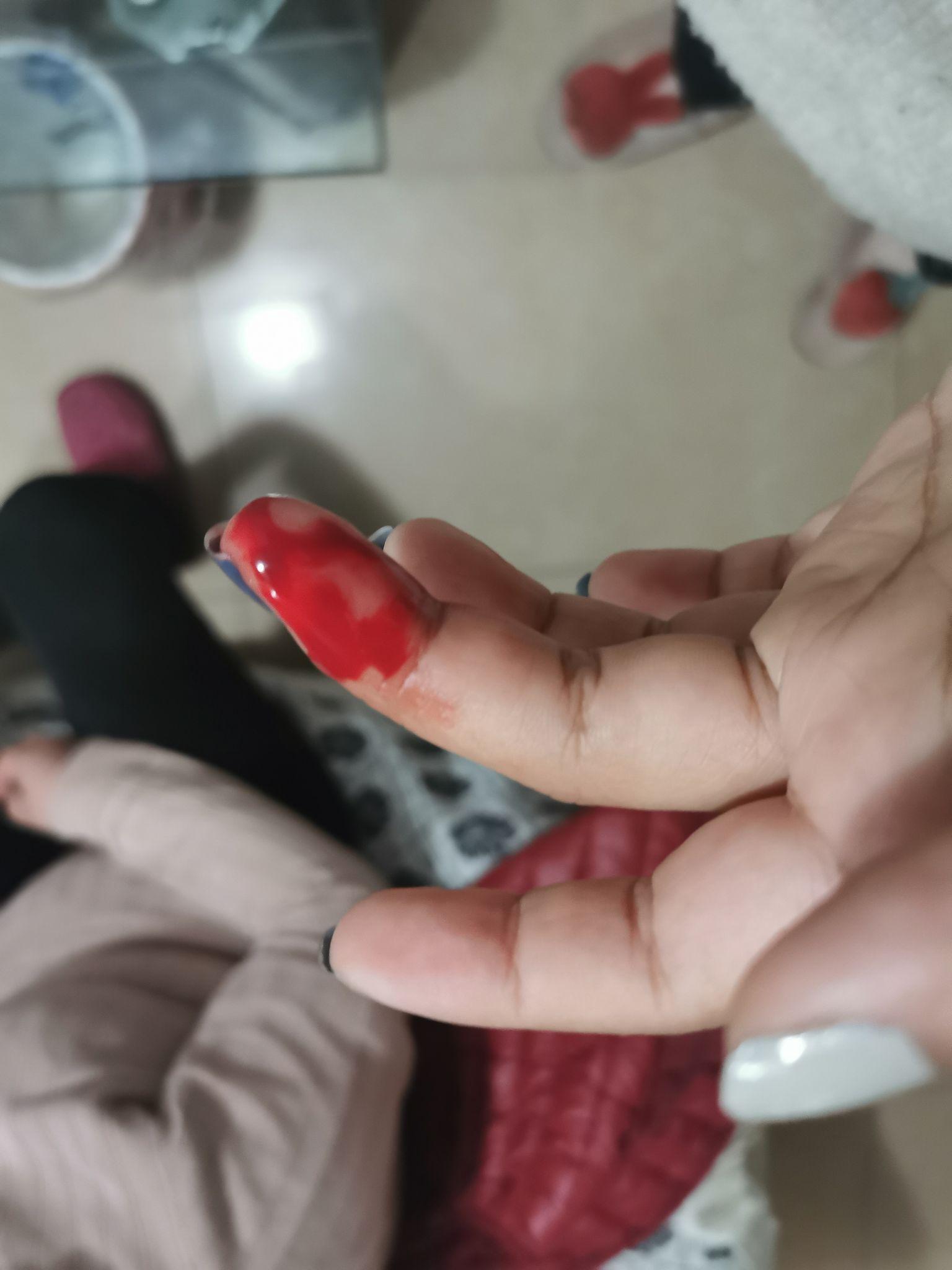 手指被刀削去一块肉,贴回去可以长好么? - 知乎