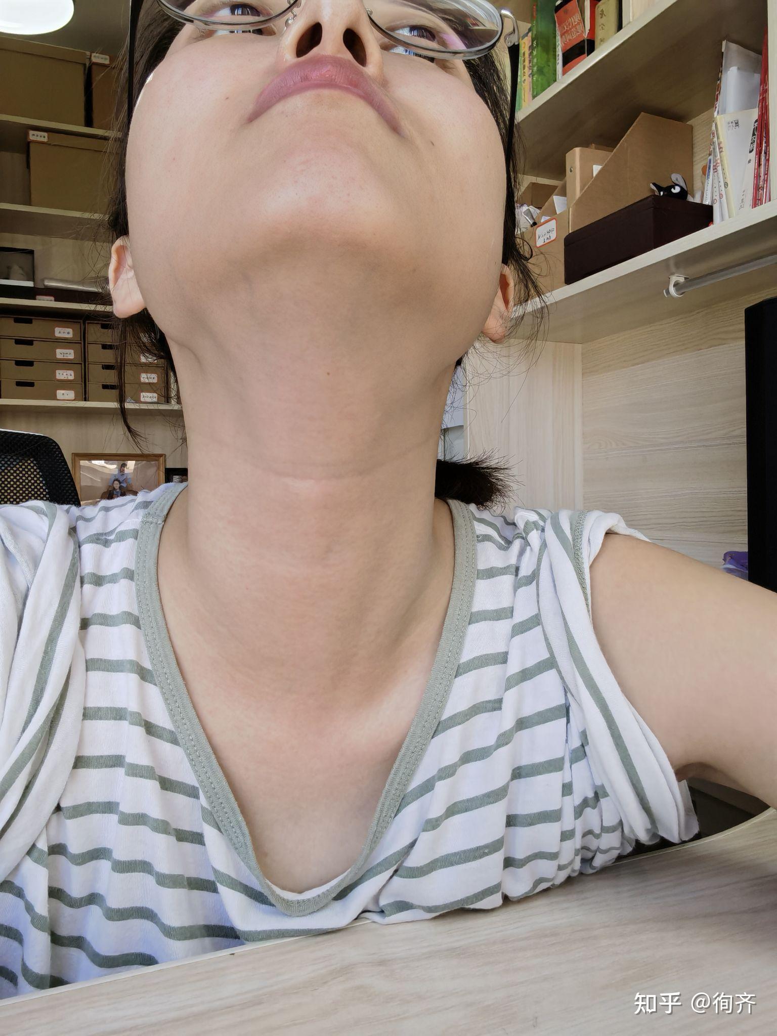 甲亢如何使脖子变正常