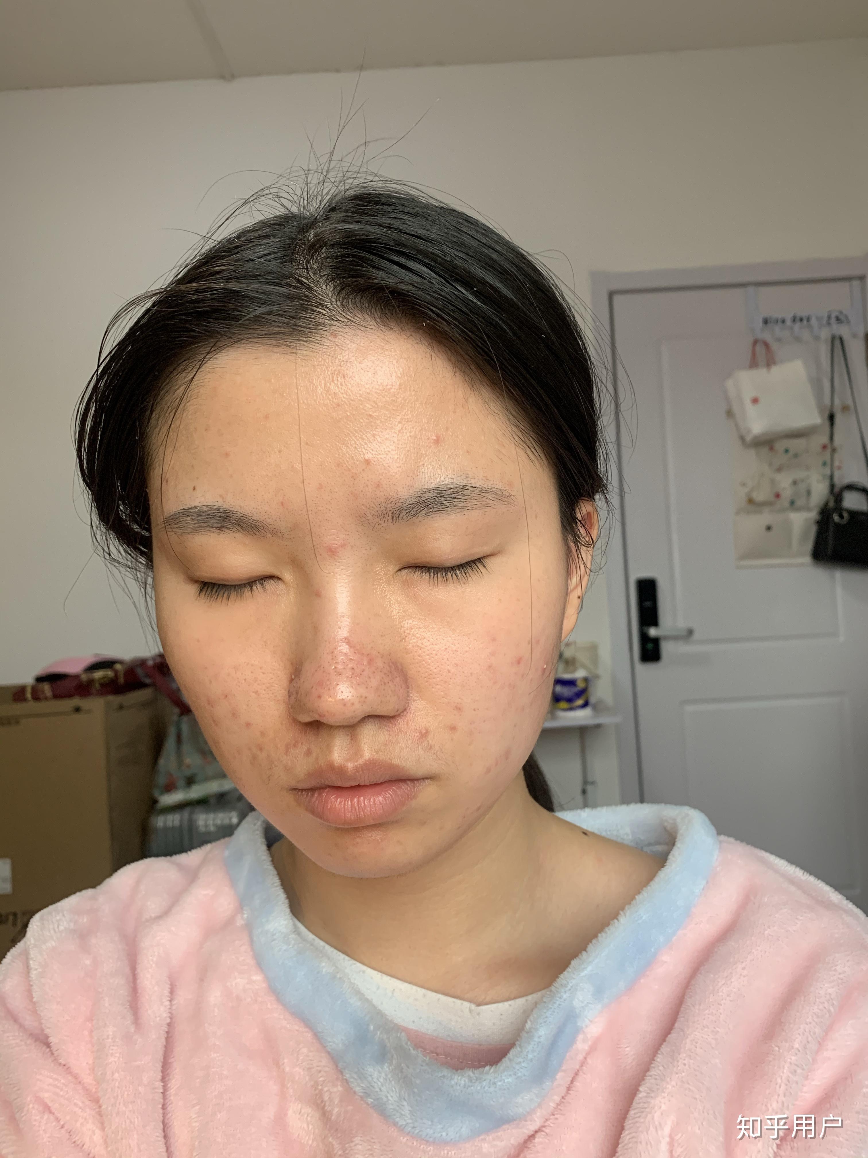 女孩子有酒糟鼻是什么样的体验?