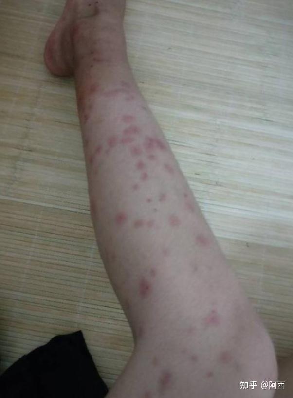 蚊虫叮咬一定会得结节性痒疹吗？ - 知乎