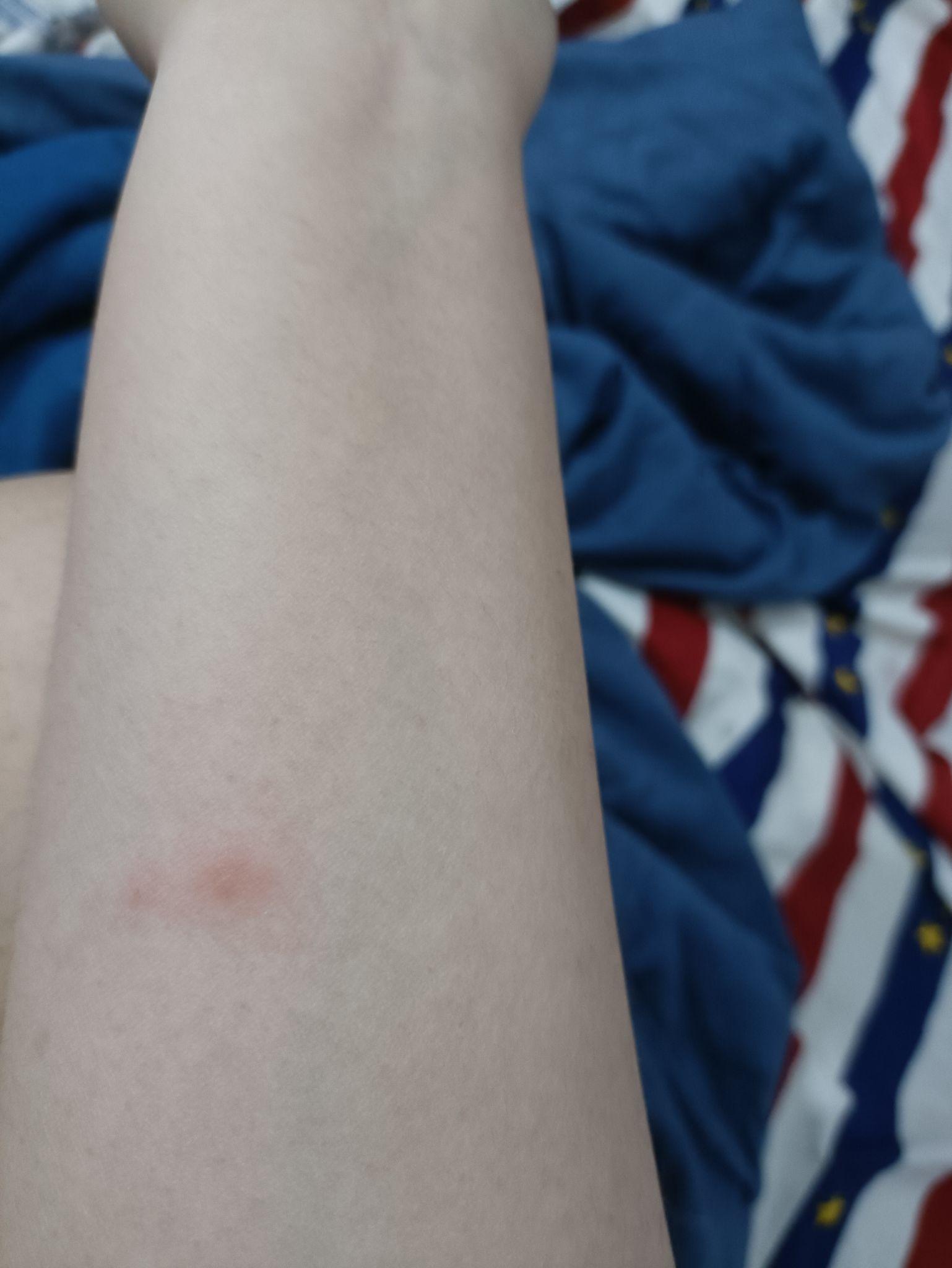 被跳蚤咬的全身都是包是什么样的感受