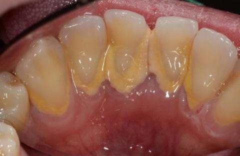 石灰牙怎么办? - 知乎