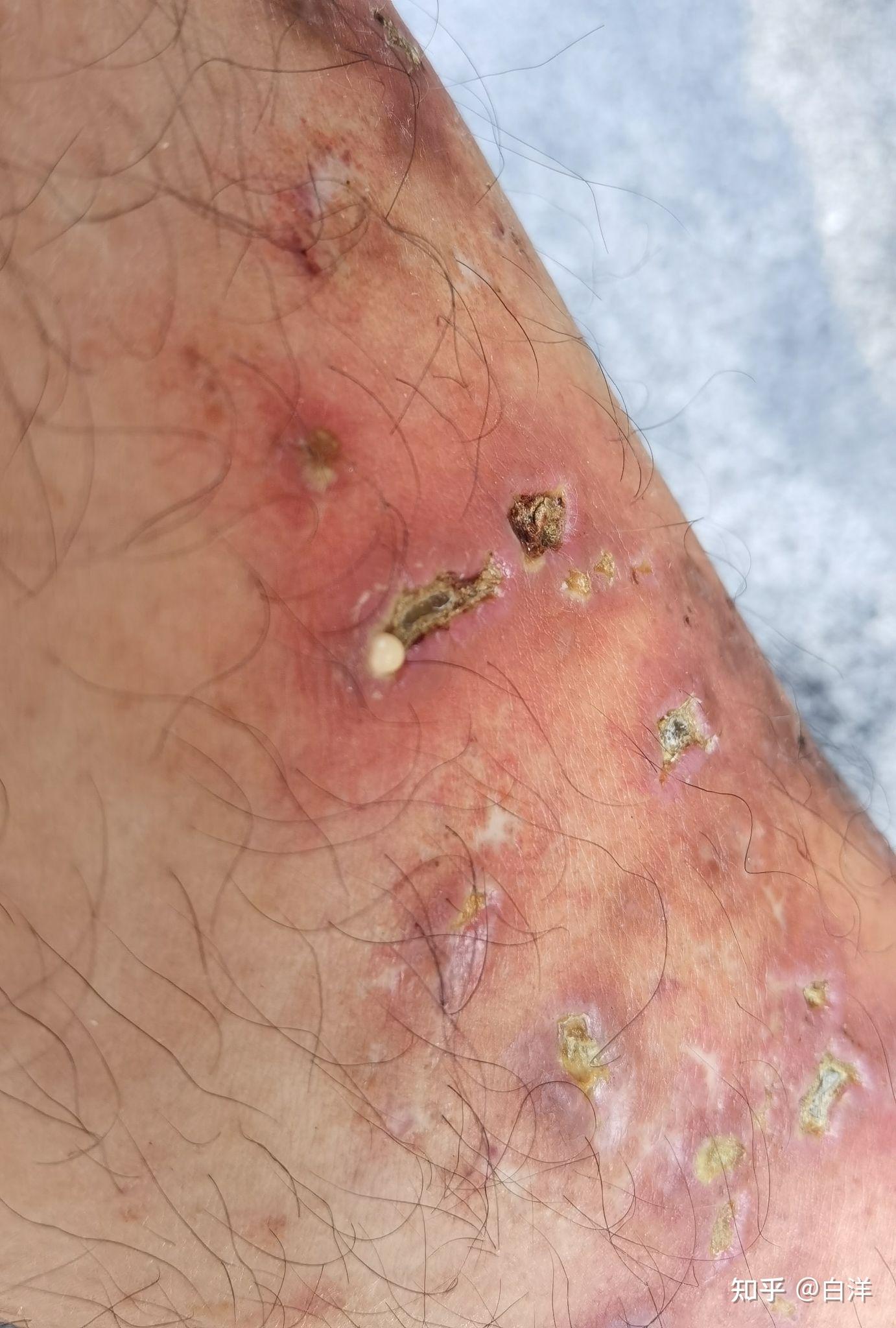 青斑性血管炎被困扰了5年之久欢迎来讨论下痊愈经历大家有痊愈的吗