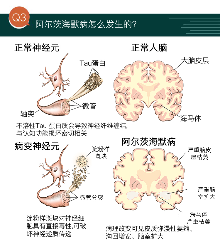 「阿尔茨海默症」是一种什么样的病症,有哪些病因与症状,该如何预防与