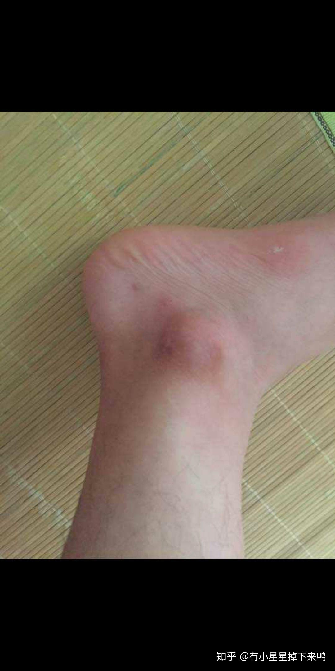 脚踝骨是黑的? - 知乎