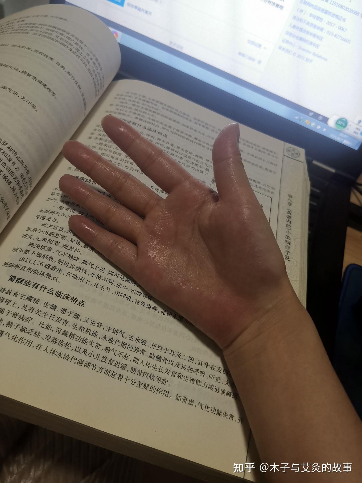 女生手心脚心出汗严重怎么办