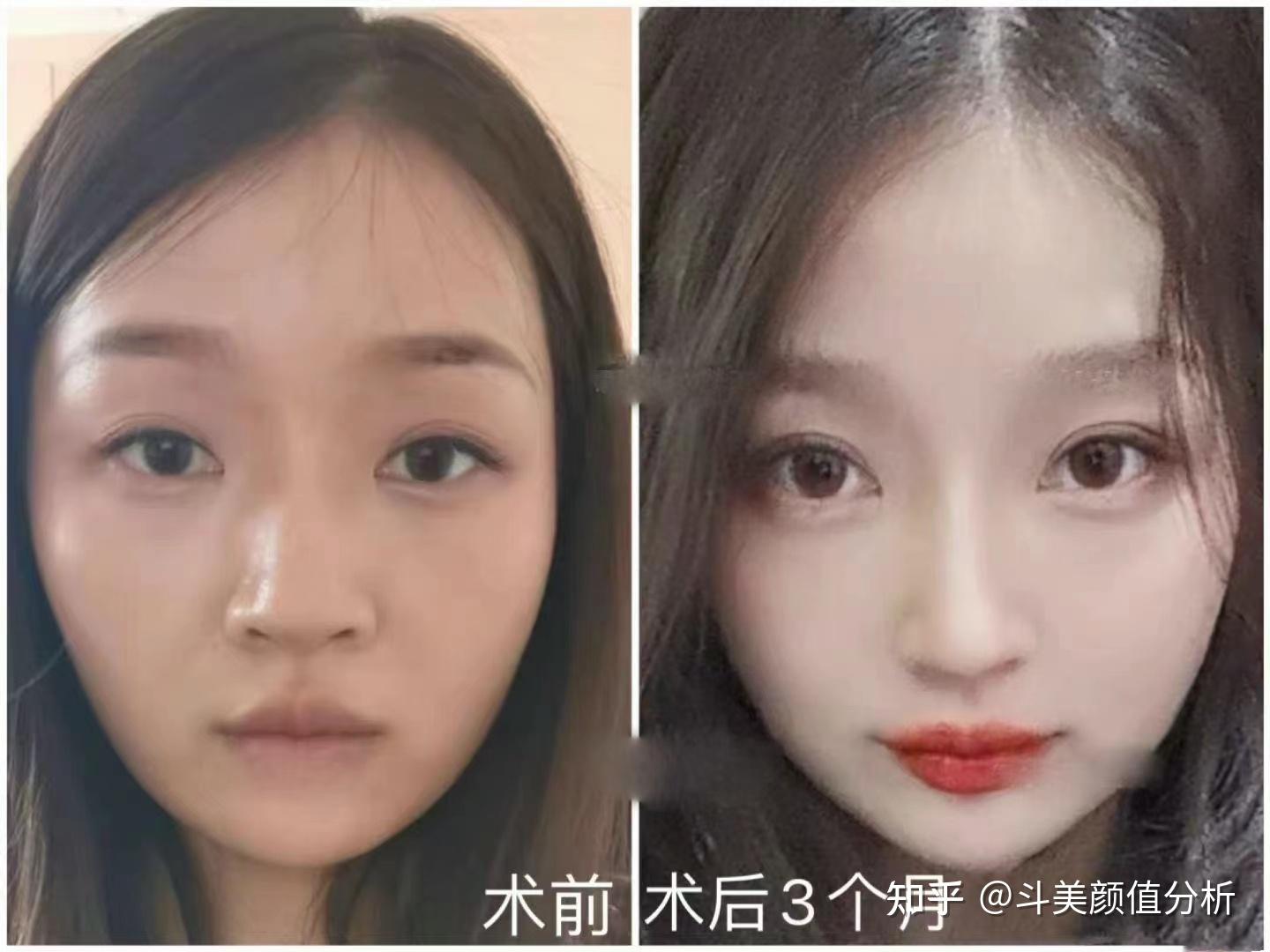 昆明做双眼皮哪家医院医生可以 最近想去做 选择纠结 奔溃了? - 知乎