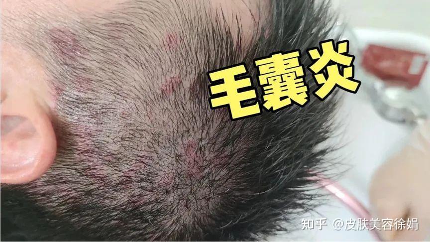 头皮上的毛囊炎，是什么原因引起的？ - 知乎