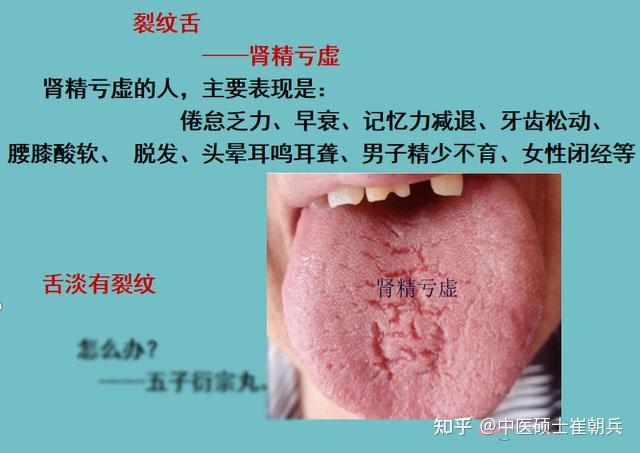 舌头有裂纹?5种原因,9种舌象,看看你是属于哪一种? - 知乎