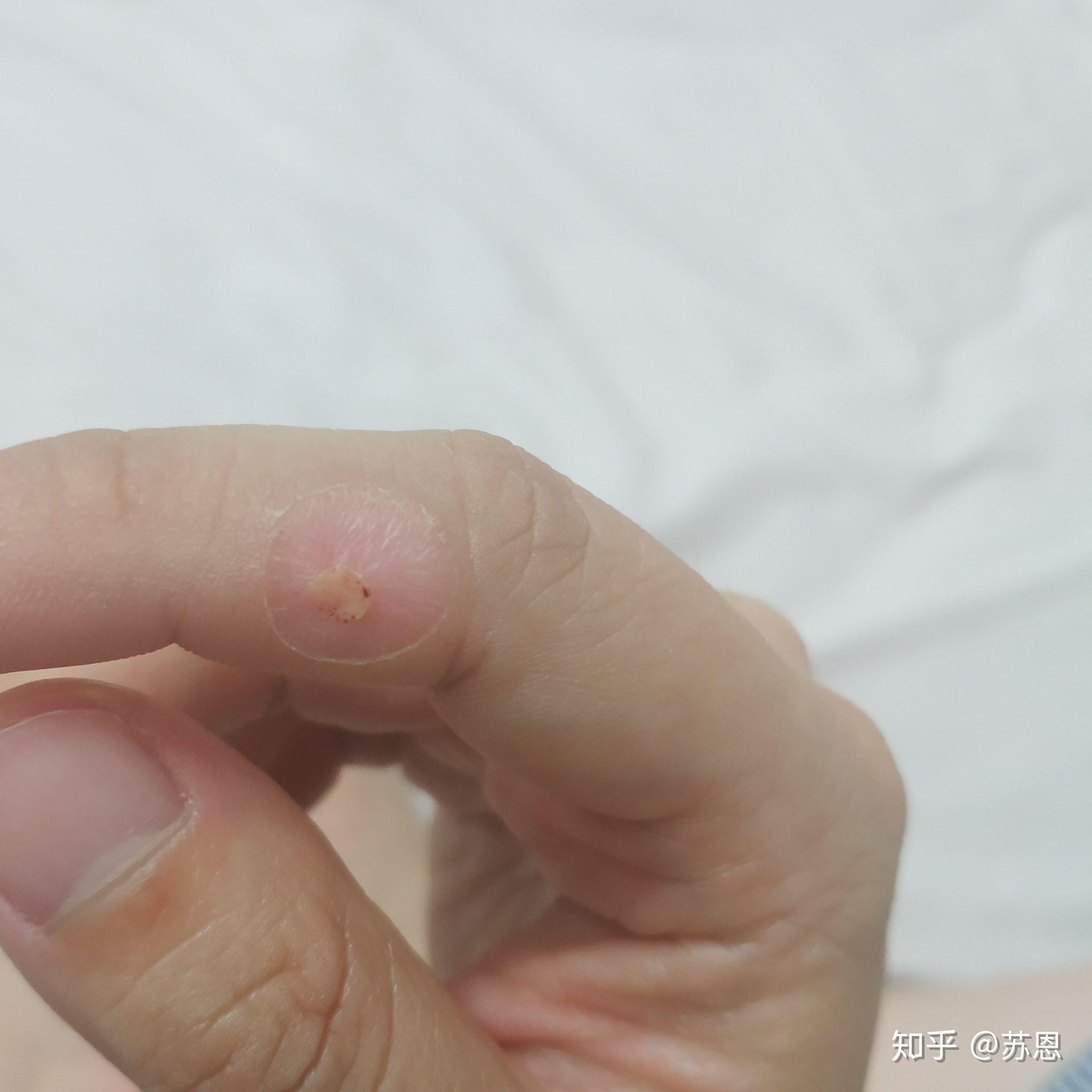 液氮冷冻治疗后手指上出了血泡而且越来越大该怎么办? - 知乎