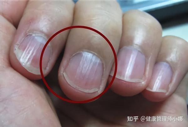 手掌正常吗,是不是肝掌?