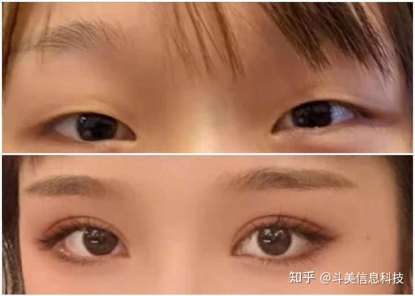 15w这种情况的眼睛主要先矫正眼睛的肌无力,先让眼睛的眼皮有能力抬