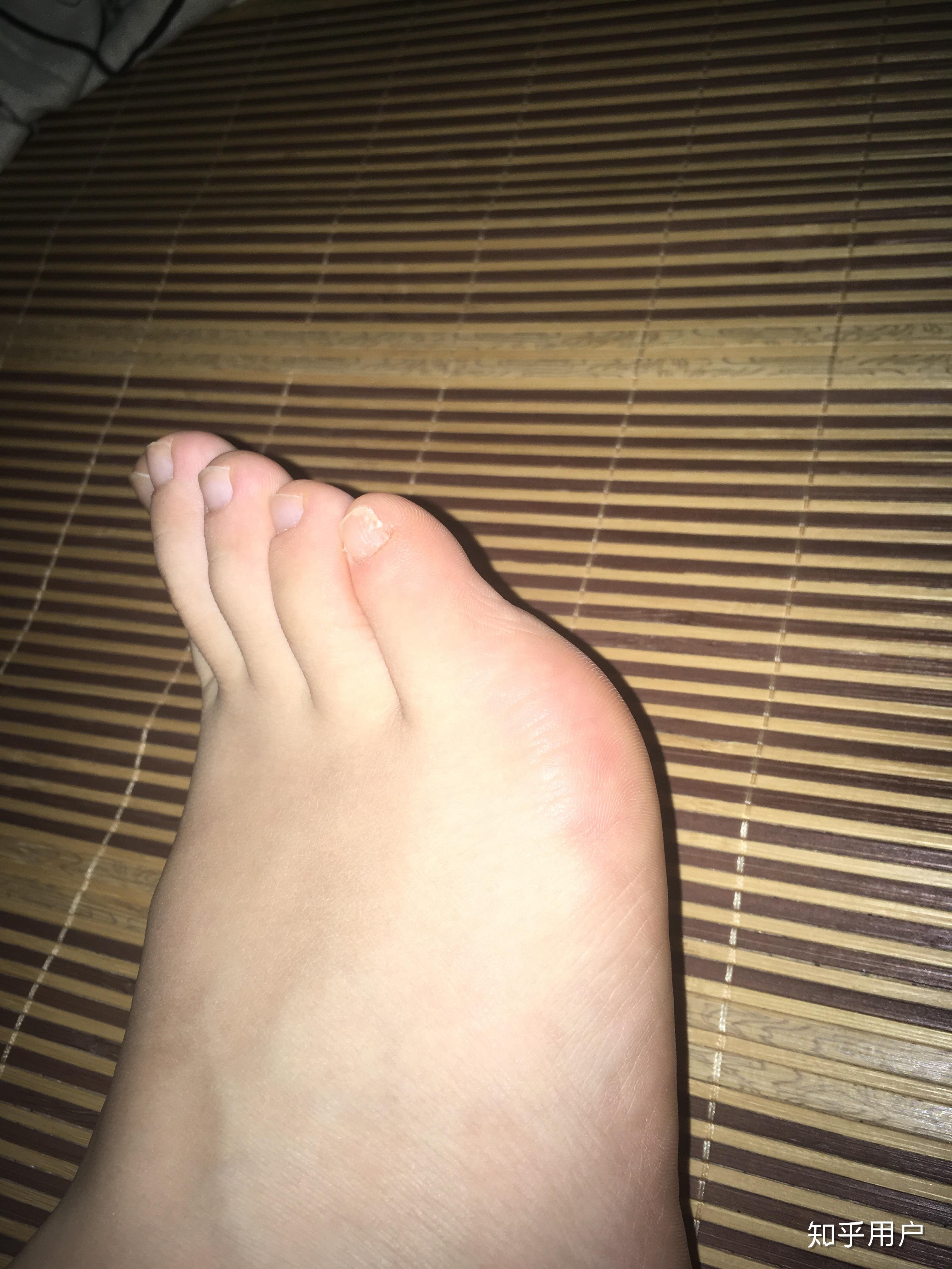 脚型太宽小拇脚趾外翻怎么办有什么解决办法吗