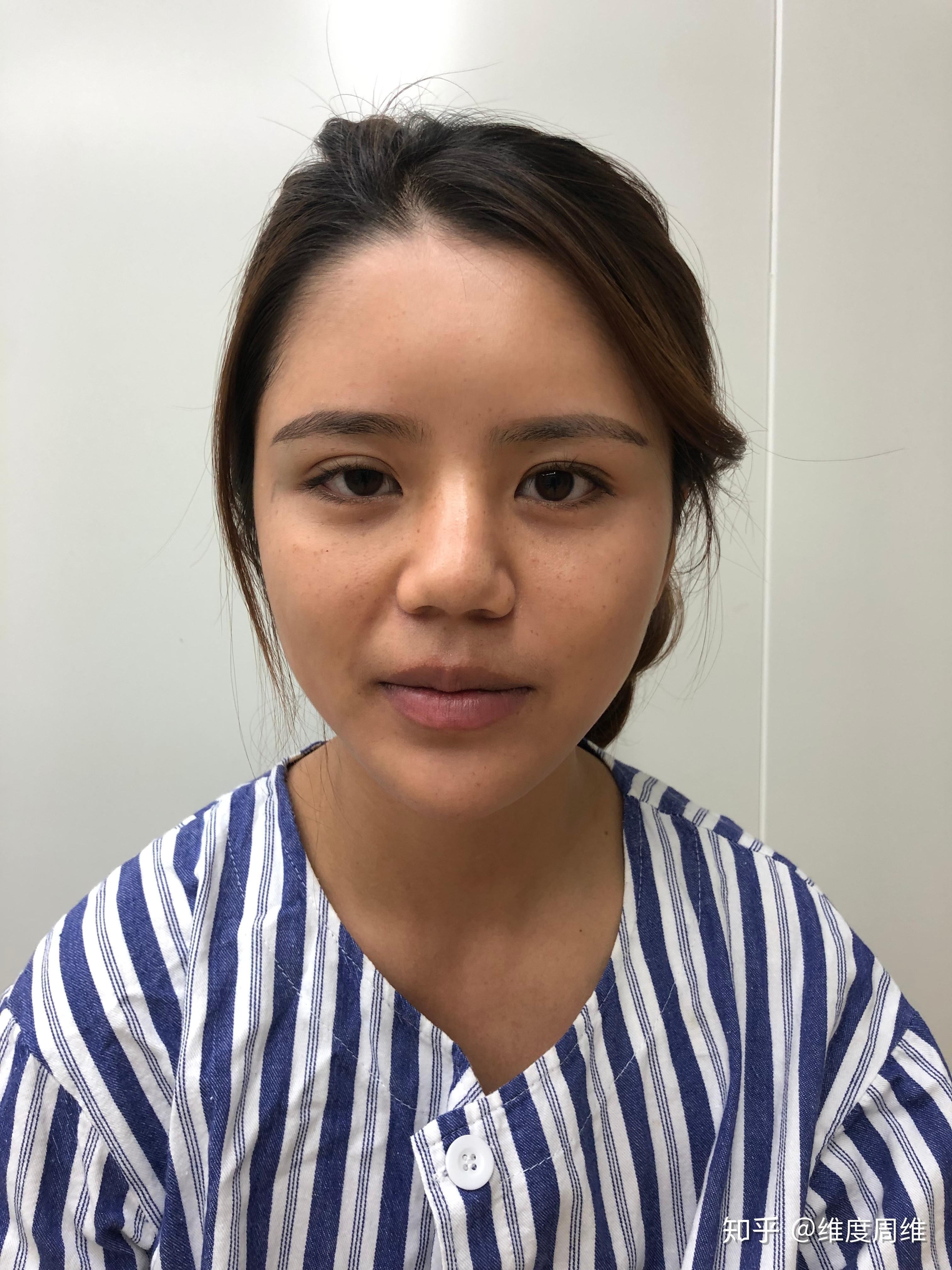 女生鼻翼大怎么办(蒜头鼻)? - 知乎