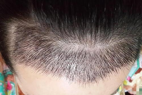 植发仍然疼痛(植发后痛得让人受不了)